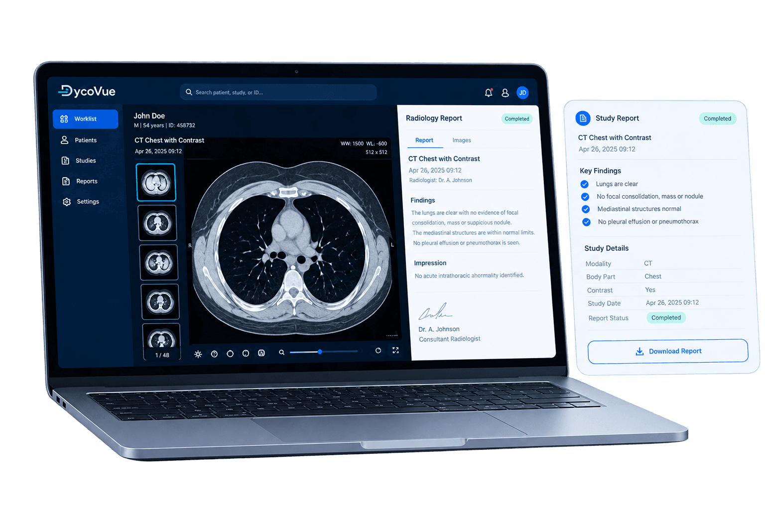 DycoVue PACS on a laptop showing a chest CT and radiology report